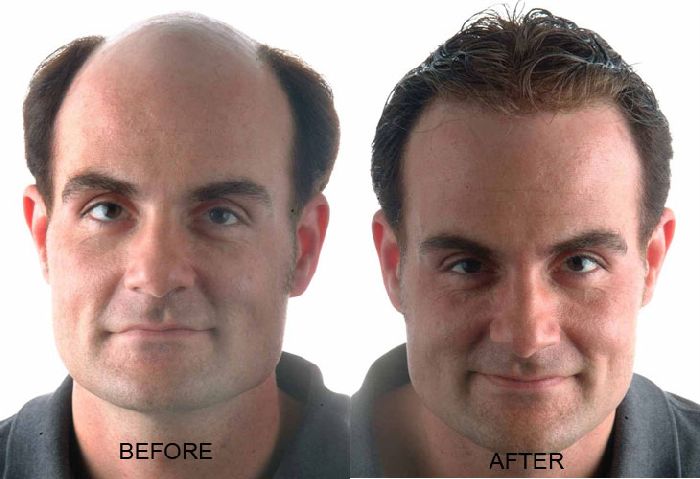 best hair regrow treatment in india
